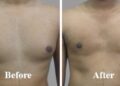 Everything you need to know about the gynecomastia in India