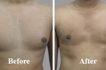 Everything you need to know about the gynecomastia in India