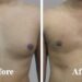 Everything you need to know about the gynecomastia in India