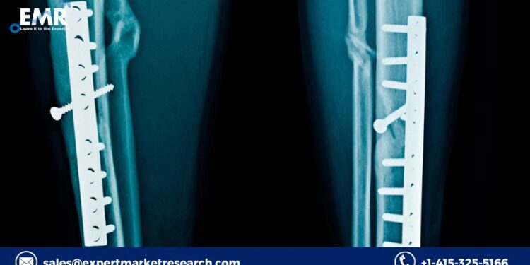 Condylar Plate Fixation System Market