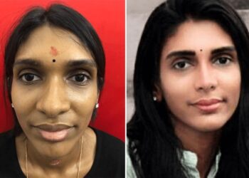 What are the primary Benefits of Nose Surgery?