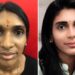 What are the primary Benefits of Nose Surgery?