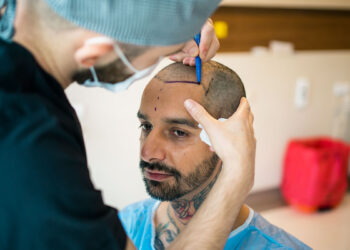 Are you searching for the top hair transplant and restoration treatment in Delhi?