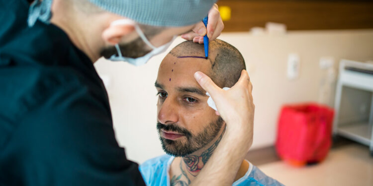 Are you searching for the top hair transplant and restoration treatment in Delhi?