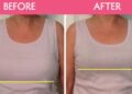 breast reduction in Ludhiana