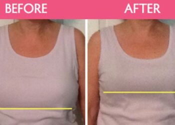 breast reduction in Ludhiana