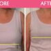 breast reduction in Ludhiana